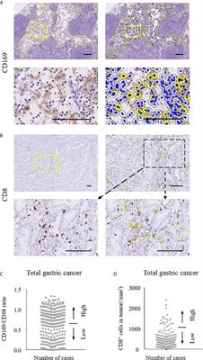 CD169 Expression on Lymph Node Macrophages Predicts in Patients With Gastric Cancer